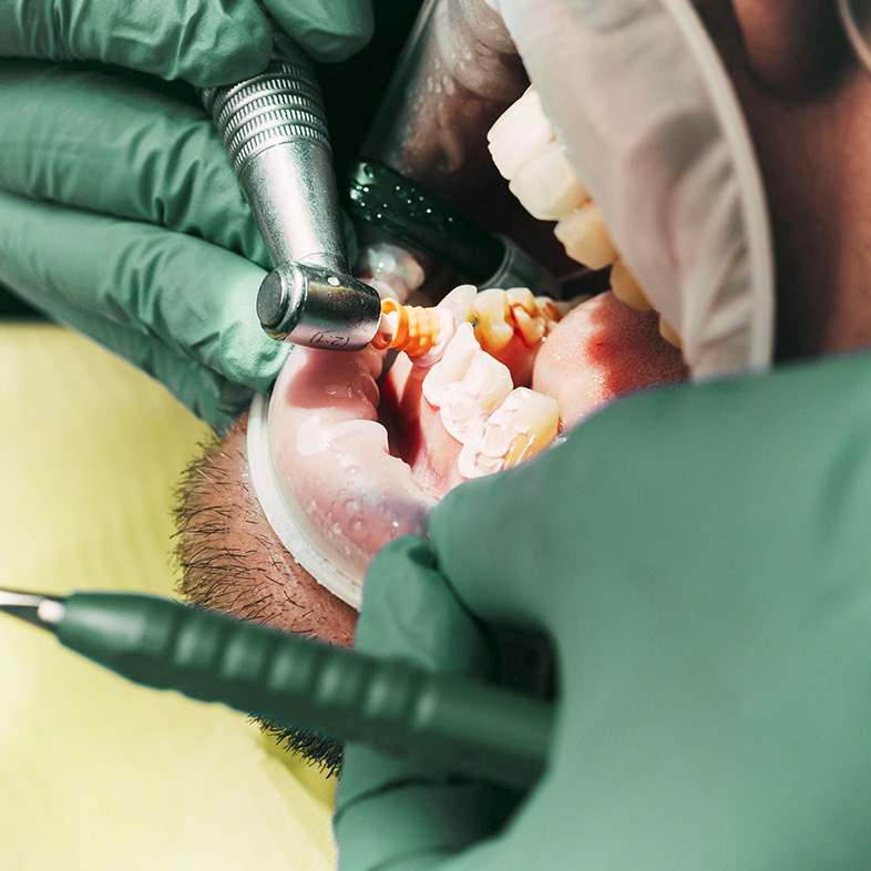 Detailaufnahme eines Gebisses in einer Prophylaxe-Behandlung im Zentrum für Zahnmedizin Dr. Sorg & Kollegen
