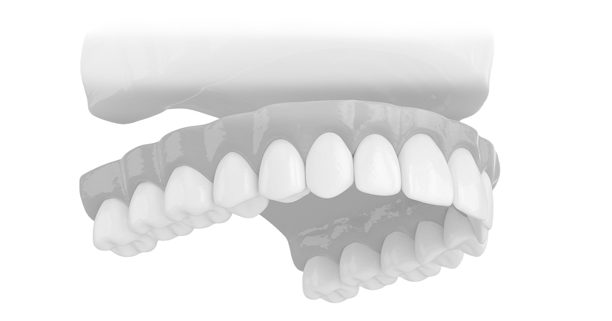 Eine Abbildung für herausnehmbaren Zahnersatz, von der Zahnarztpraxis Dr. Sorg und Kollegen in Welzheim